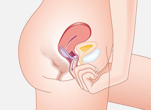 step in inserting diaphragm