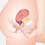 finding cervix and public bone before inserting diaphragm