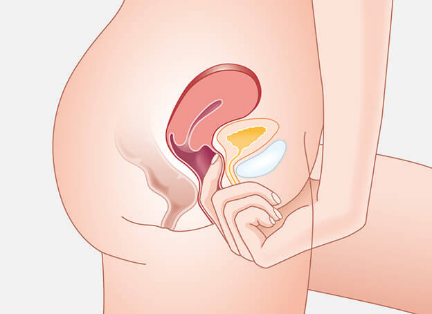 finding cervix and public bone before inserting diaphragm