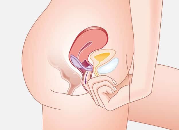 Removing the diaphragm